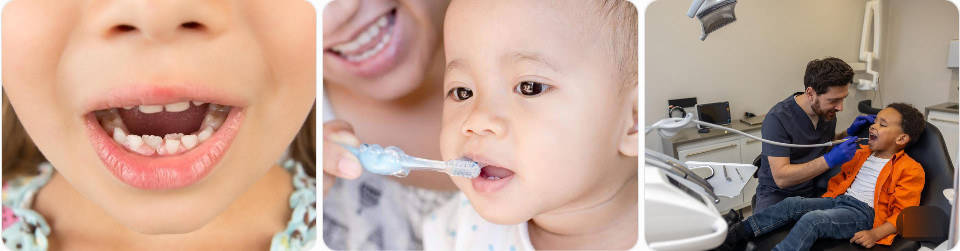 Răng mọc lệch ở trẻ em